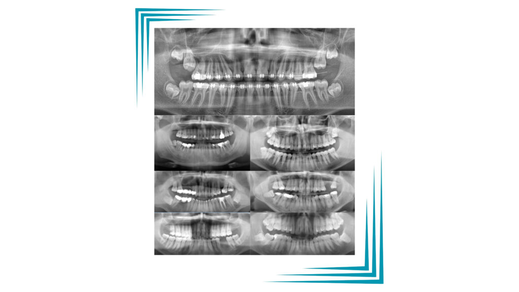 rx denti del giudizio