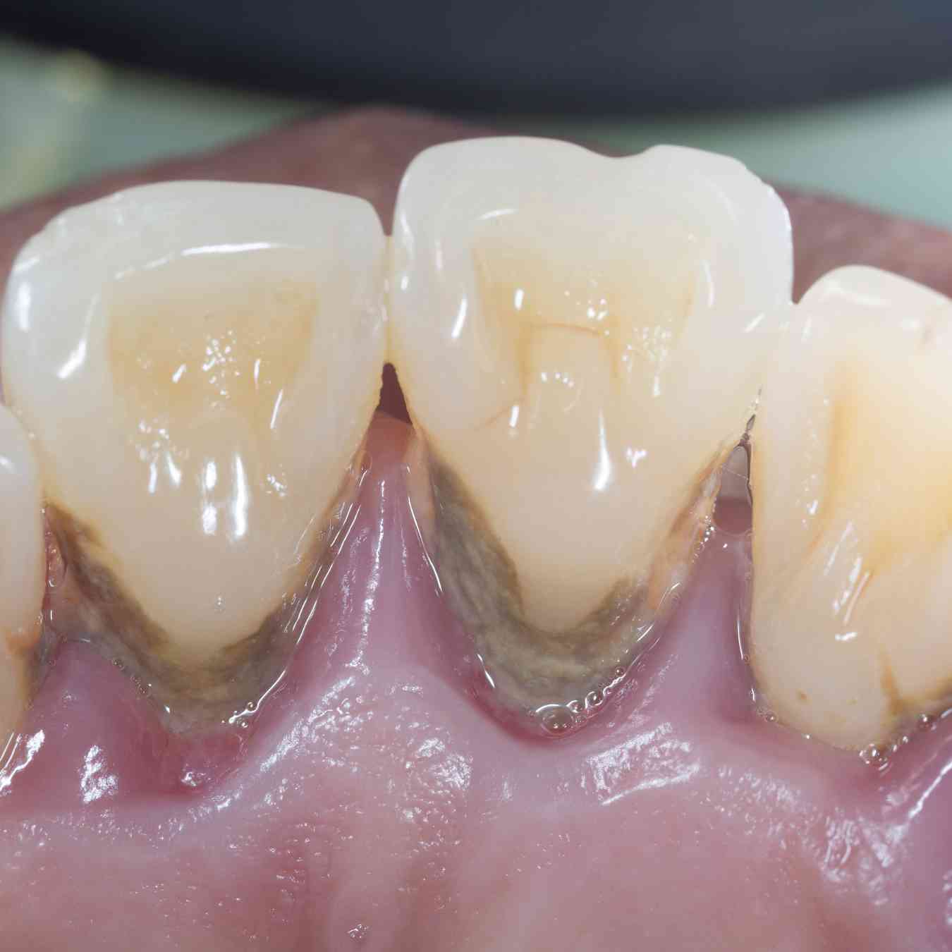 allineatori trasparenti