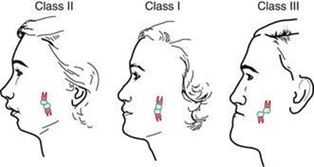 come si presenta la classe dentale