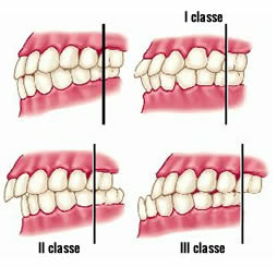 Immagine che descrive le classi dentali, dalla prima alla terza.