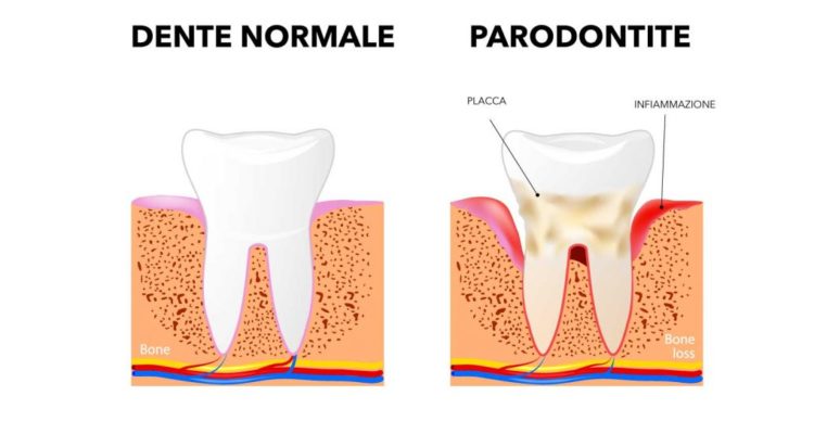 Immagine che descrive le classi dentali, dalla prima alla terza.